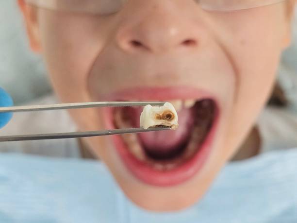 Best Broken or Chipped Tooth Repair in Millen, GA